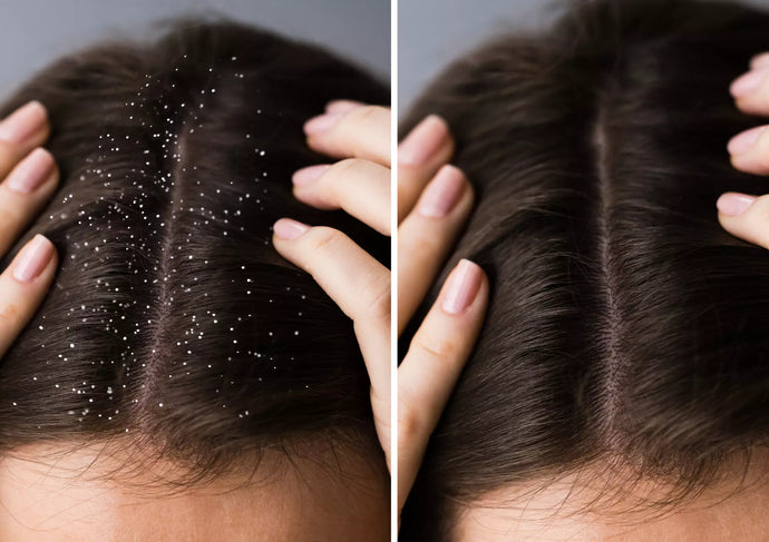 2 imagenes una de cuero cabelludo repleto de caspa y el otro sano después de usar champú de CBD